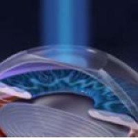 Лазерная коррекция зрения - операция