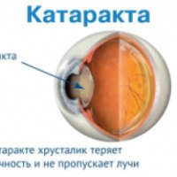 Операция по удалению катаракты с заменой хрусталика