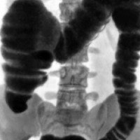 Ирригоскопия (рентген кишечника)