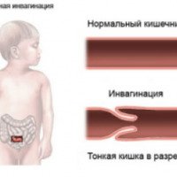 Инвагинация кишечника