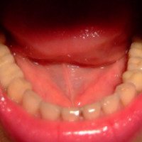 Зубные импланты Alfa Bio
