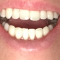 Отбеливание зубов системой Beyond