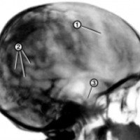 Процедура: R-графия черепа с прицельным снимком турецкого седла
