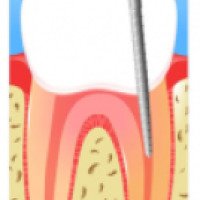 Чистка и лечение каналов зуба