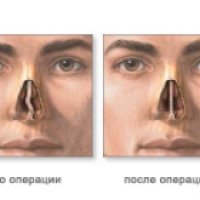 Операция по исправлению носовой перегородки