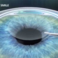 Лазерная коррекция зрения методом Smile
