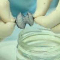 Операция эндоваскулярного закрытия дефекта межпредсердной перегородки при врожденном пороке сердца