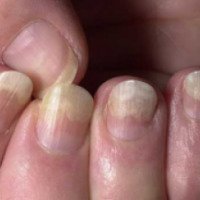 Как правильно лечить грибок ногтей