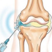 Процедура внутрисуставной инъекции в коленный сустав