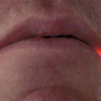 Лечение лазером герпеса на губах